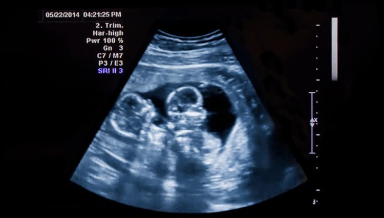 Symptoms of Twins - Ultrasound