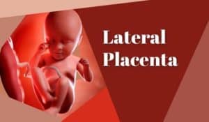 Lateral Placenta
