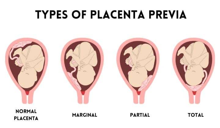 Low Lying Placenta - (Types of Placenta Previa)