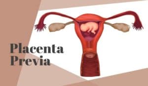 Placenta Previa - Low lying Placenta