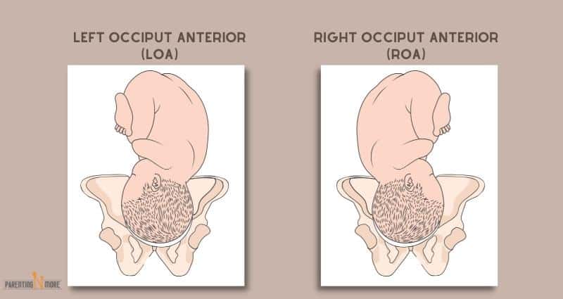 Baby Positions - Occiput Anterior