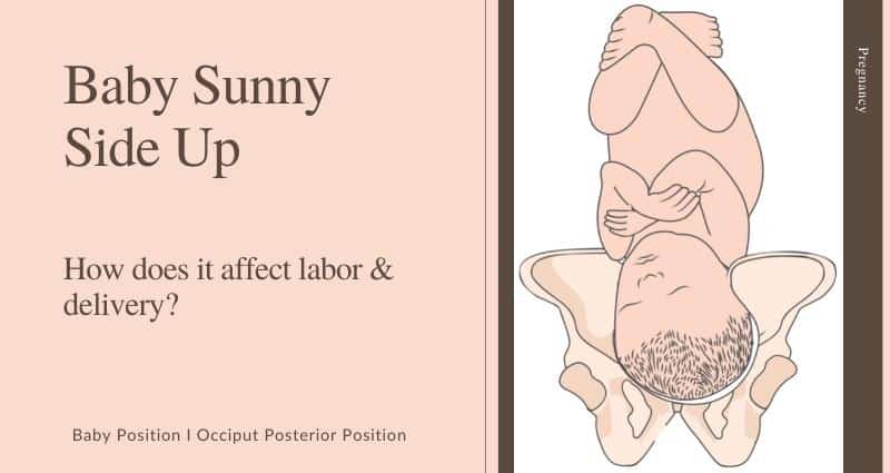 baby-sunny-side-up-understanding-the-occiput-posterior-position