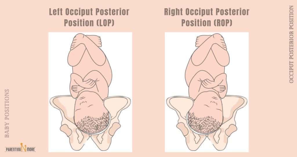 Left Occiput Posterior (LOP) and Right Occiput Posterior (ROP)