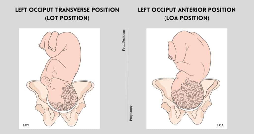Left Occiput Transverse Position (LOT) and Left Occiput Anterior Position (LOA)