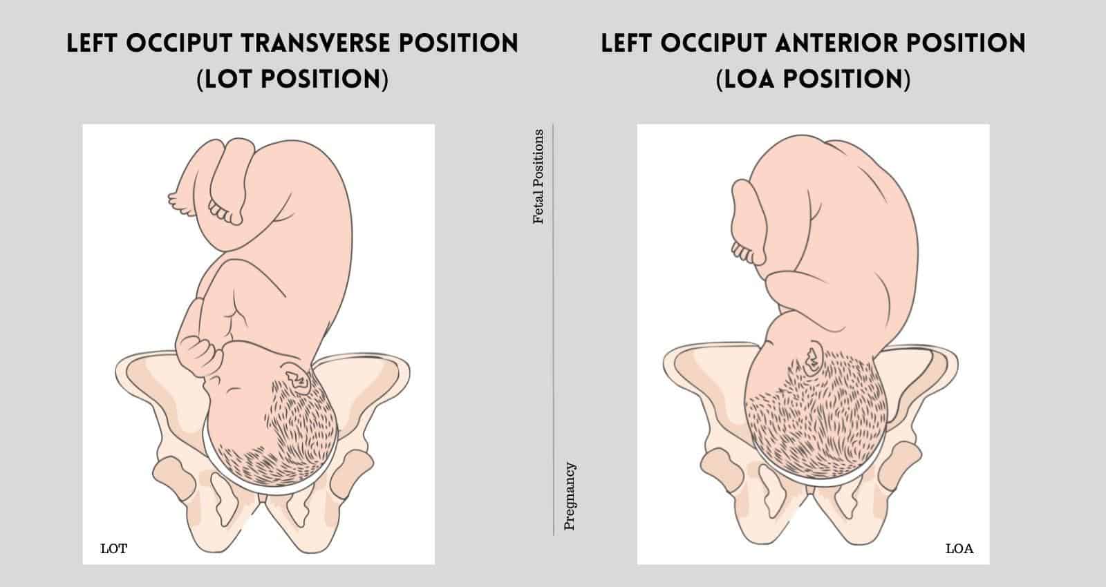 Left/Right Occiput Transverse Position: Impact on Labor & Delivery
