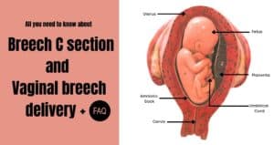 Breech C section and Viginal breech delivery