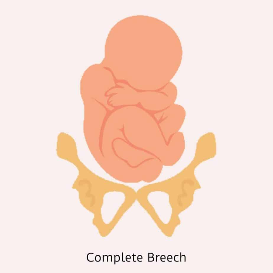 Complete Breech Presentation - Complete Breech Position