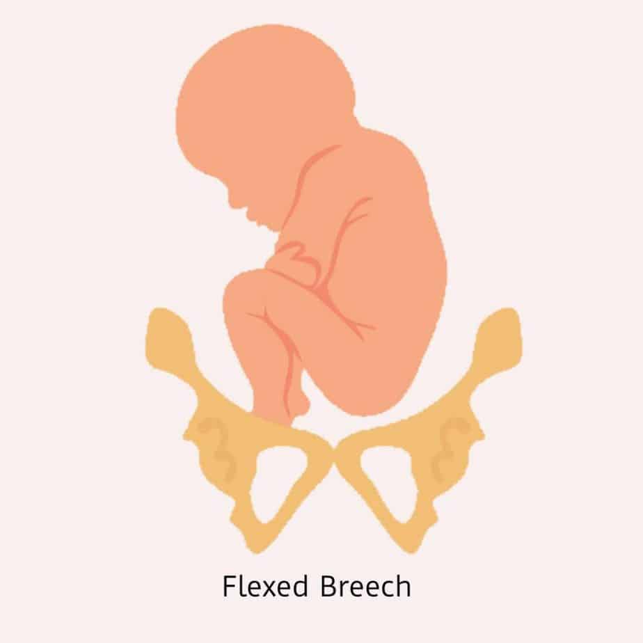 Flexed Breech Presentation
