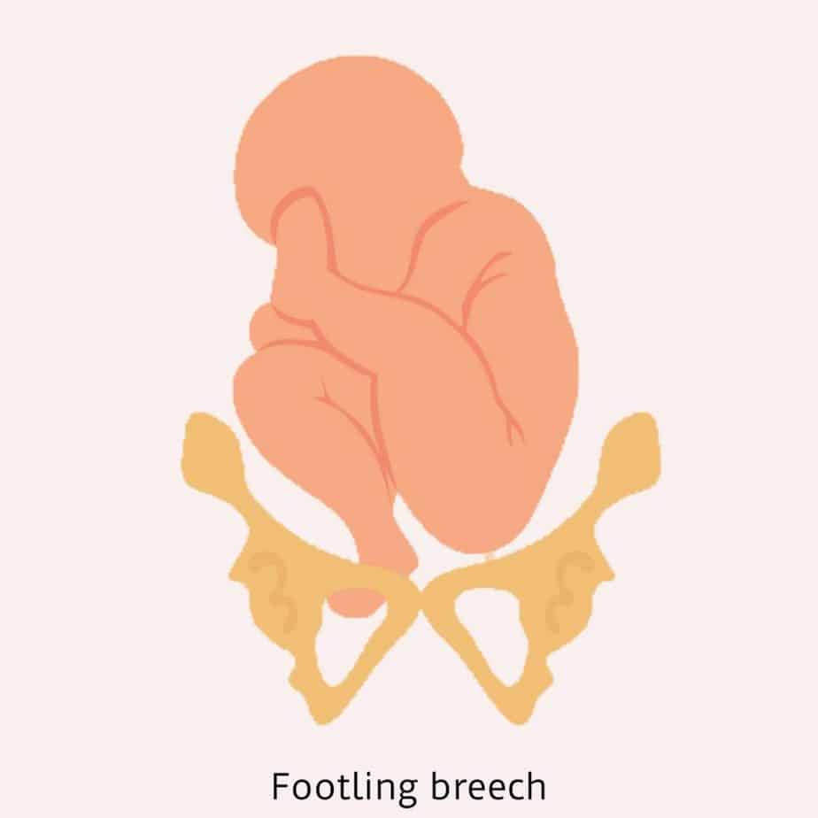 Footling Breech baby - Footling breech presentation - Incomplete Breech position