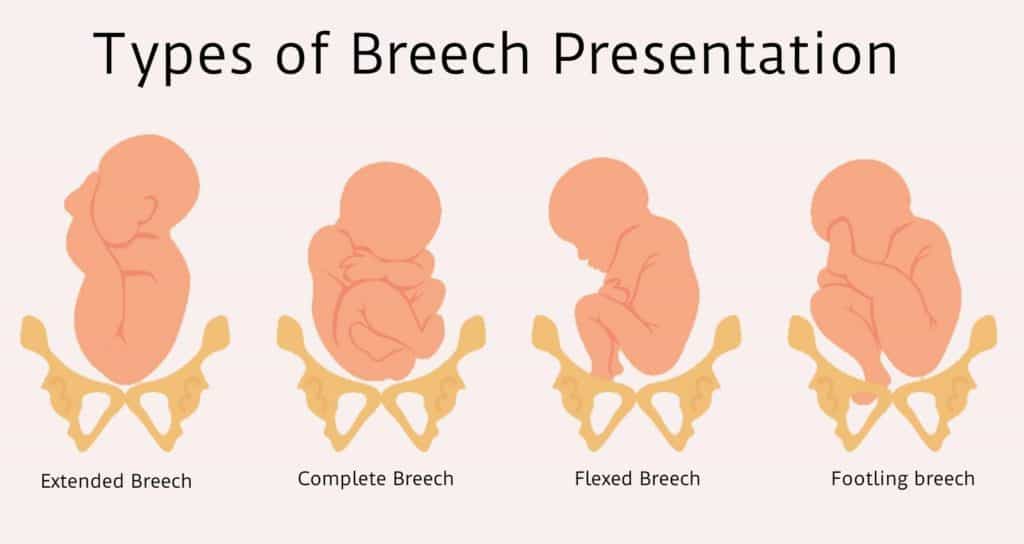 newborn breech presentation icd 10