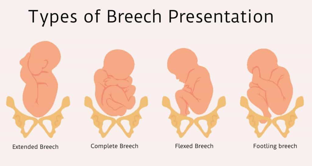 four types of cephalic presentation