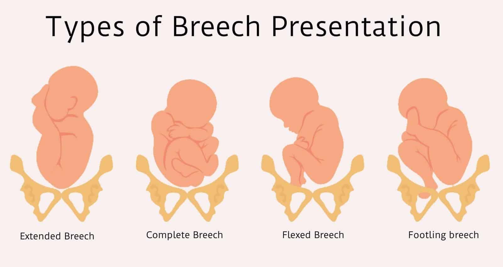 breech presentation is present in